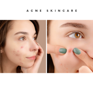 Reasons to use Acne Cleansers for Your Acne